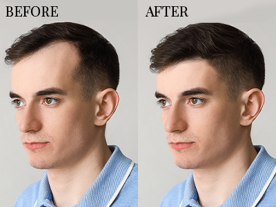 Hair Transplantatıon - Before/After