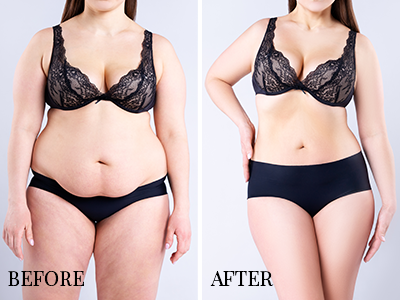 Obesity - Before- After