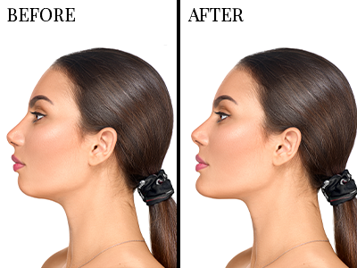 Plastic Surgery- Before/After