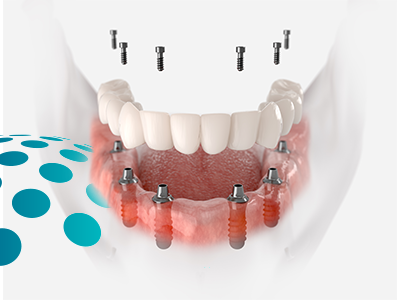 All on 4 and 6 Dental Implant
