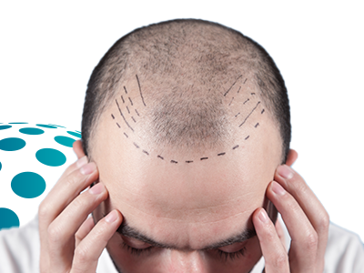 Hair Transplant with FUE Technique