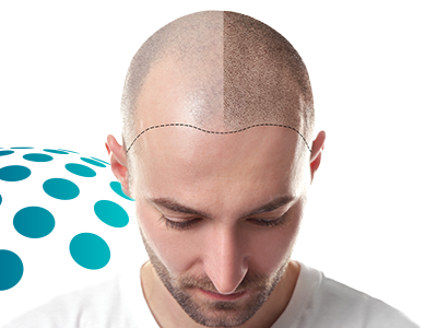 Hair Transplant with DHI Technique